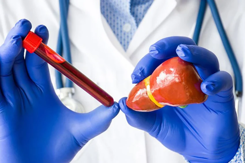 Xét nghiệm men gan giúp tầm soát sớm tình trạng viêm gan, xơ gan, u gan Xét nghiệm men gan giúp tầm soát sớm tình trạng viêm gan, xơ gan, u gan